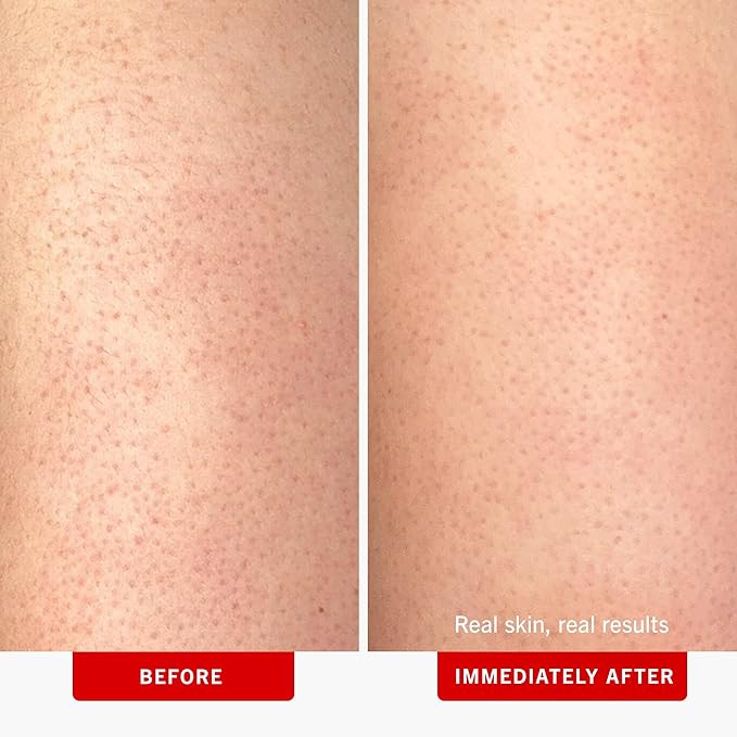 First Aid Beauty KP Bump Eraser Body Scrub with 10% AHA, Keratosis Pilaris Skin Exfoliator with Glycolic and Lactic acids, Helps Reduce Chicken Bumps, Safe for Sensitive Skin, 8 oz